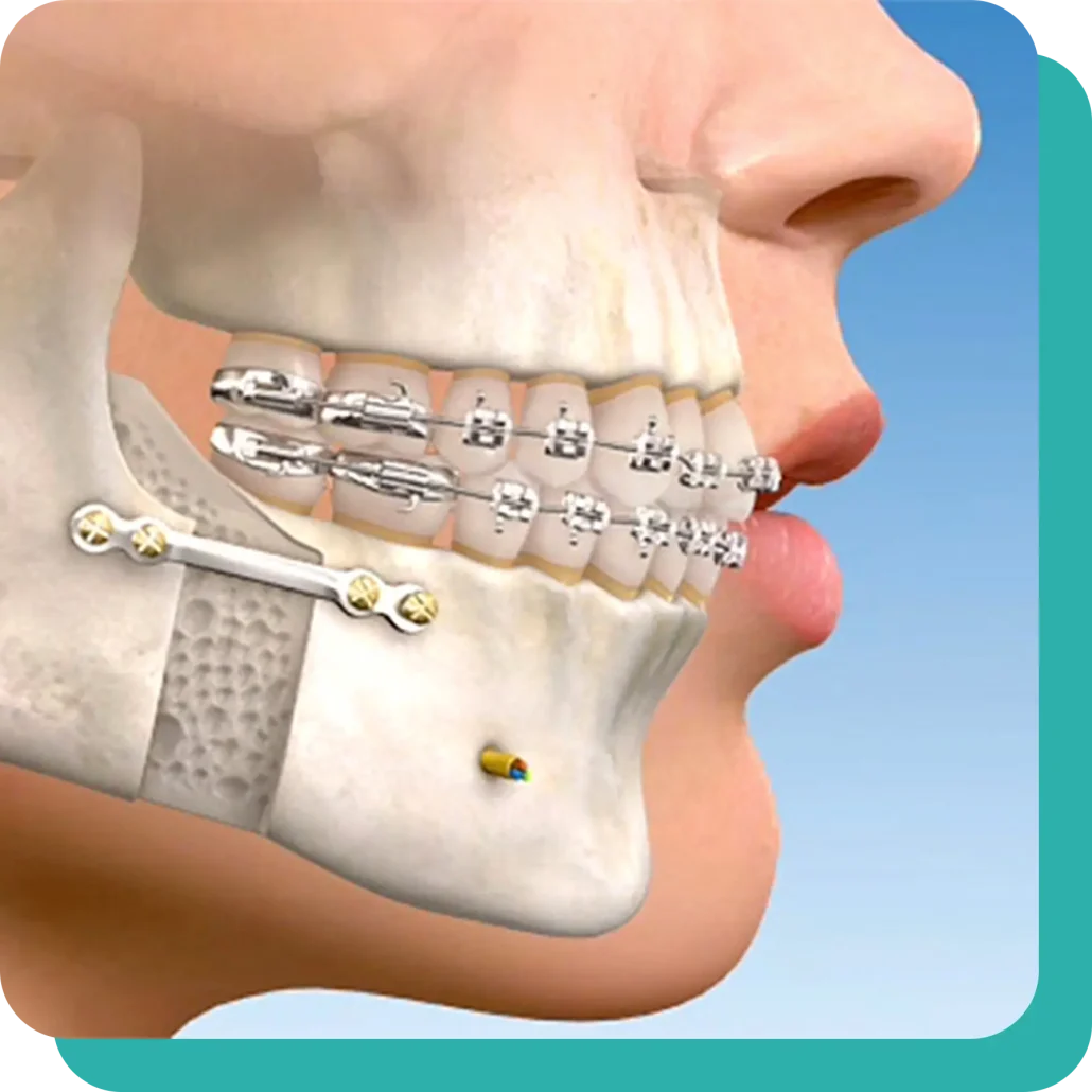 Clase II o Retrognatia Mandibular» Cirugía Ortognática - Instituto